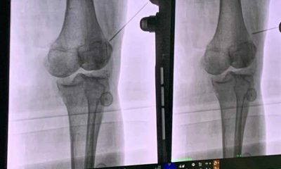 Mal di schiena e dolori cronici, cure innovative al San Leonardo di Castellammare 21 Castellammare